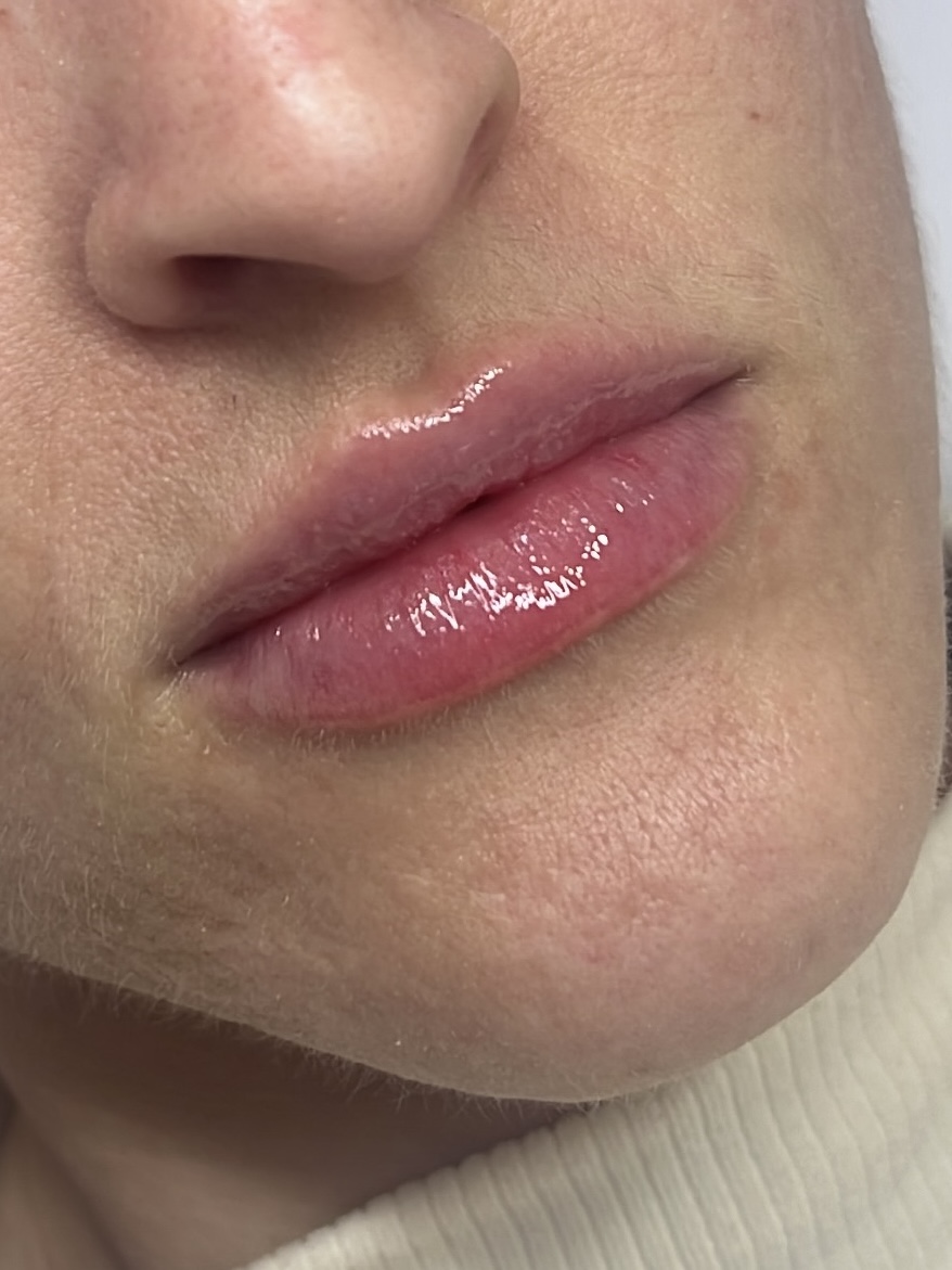 Bia depois do preenchimento labial